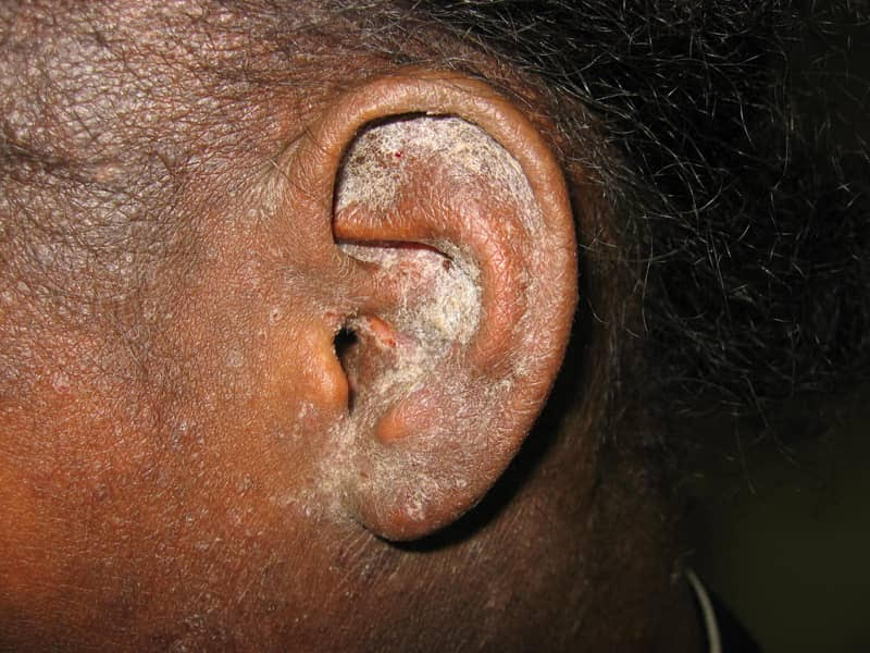 SCABIES CASES ESCALATE COUNTRYWIDE – Eagle FM